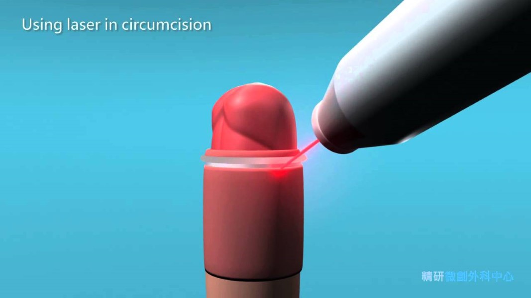 Doctor Lasers Off Boy’s Penis During Circumcision By Accident (3)